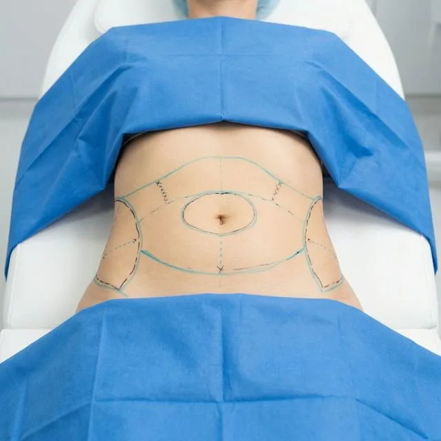 Liposuction (Yağ Emilimi)
