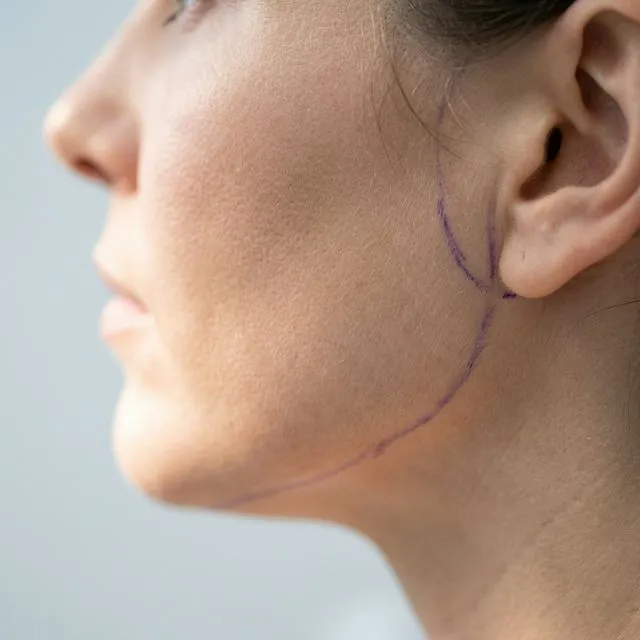 Yüz Germe (Face Lift)